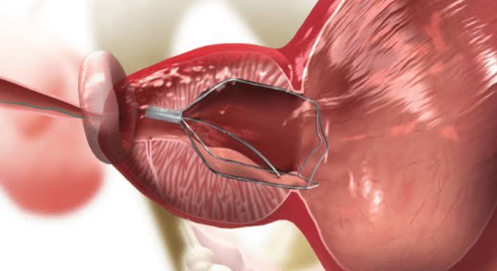 iTind temporary implantable nitinol device